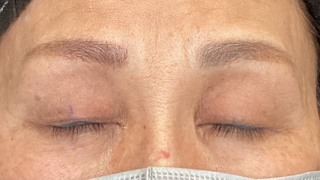 手術前の状態 その1