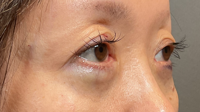 手術前の状態 その1