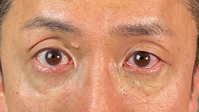 手術前の状態 その1