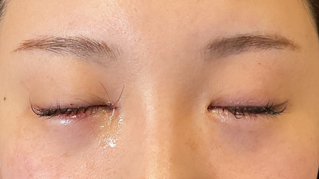 手術前の状態 その1