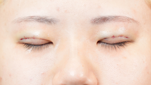 手術前の状態 その1