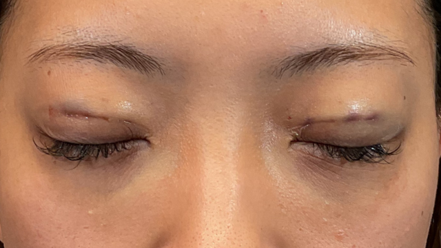 手術前の状態 その1