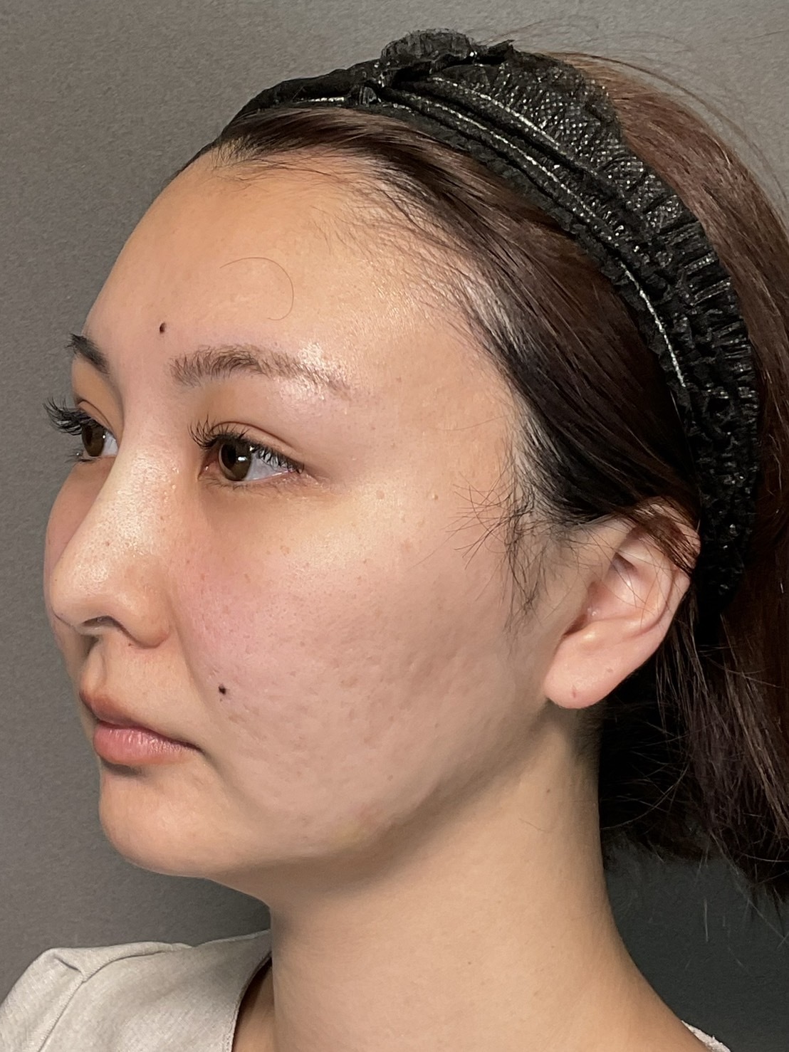 手術前の状態 その1