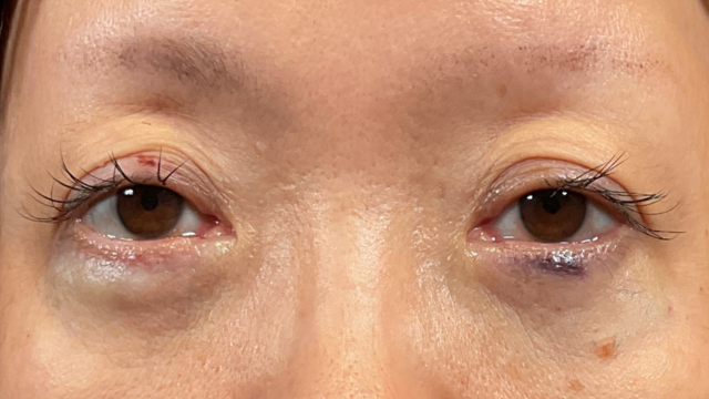 手術前の状態 その1