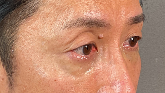 手術前の状態 その1