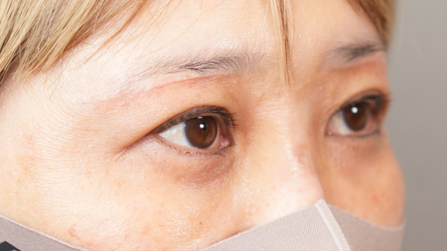 手術前の状態 その1