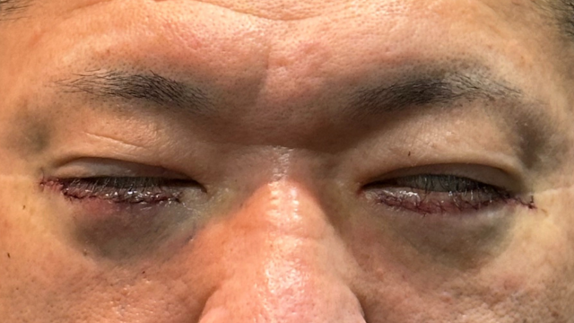 手術前の状態 その1