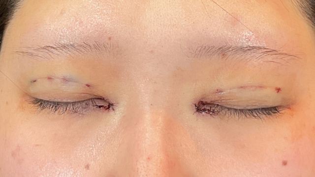 手術前の状態 その1