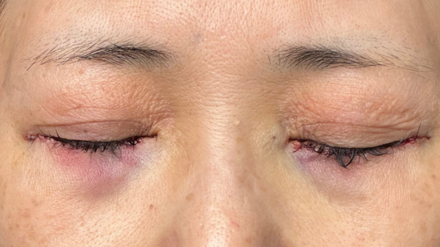 手術前の状態 その1