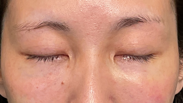 手術前の状態 その1