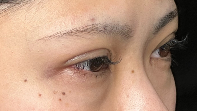 手術前の状態 その1