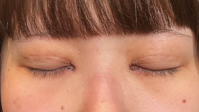 手術前の状態 その1