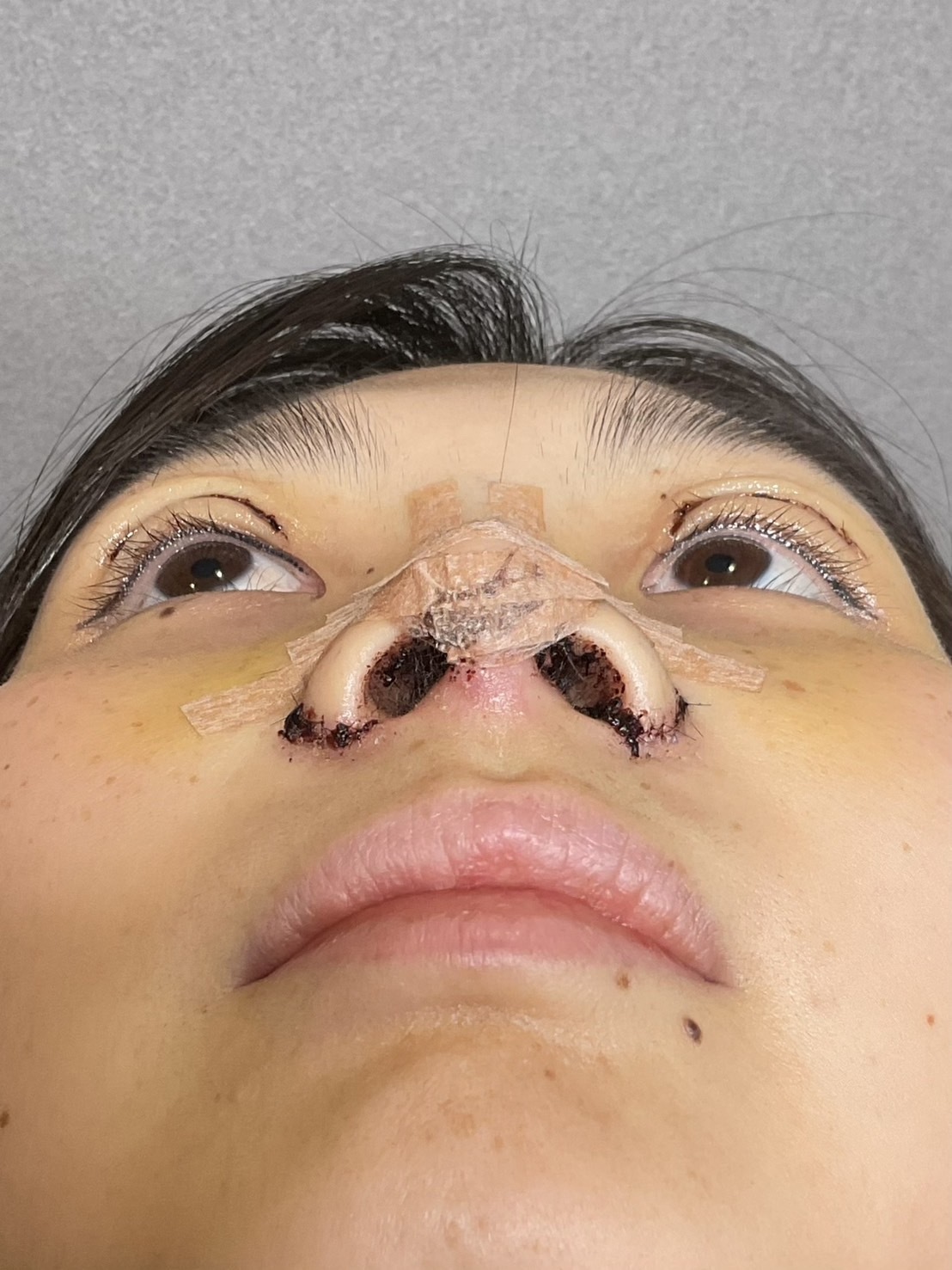 手術前の状態 その1