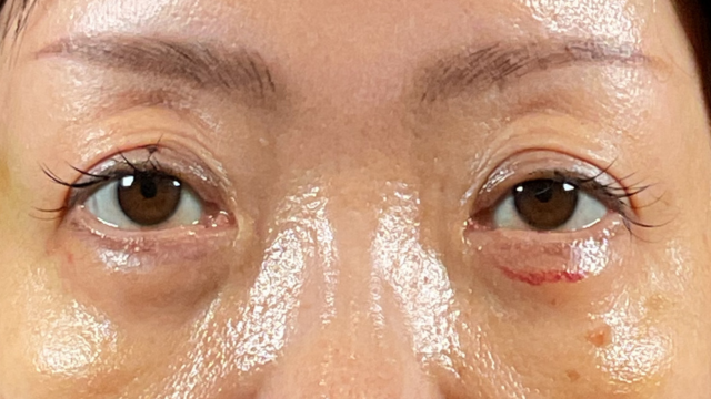 手術前の状態 その1