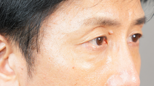 手術前の状態 その1