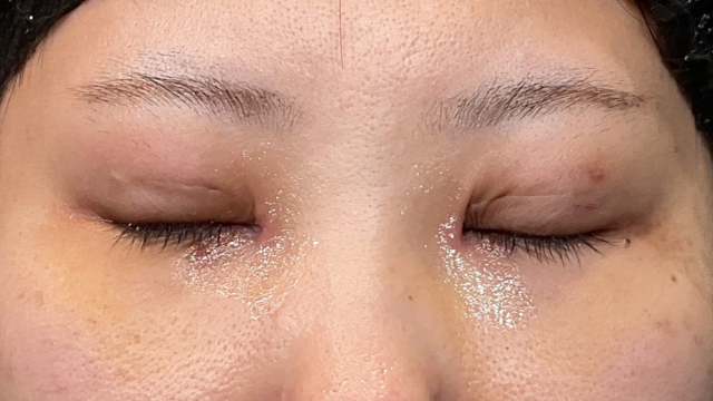 手術前の状態 その1