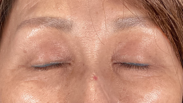 手術前の状態 その1