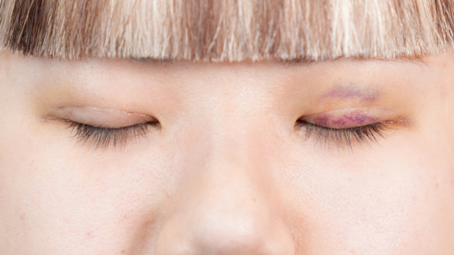 手術前の状態 その1