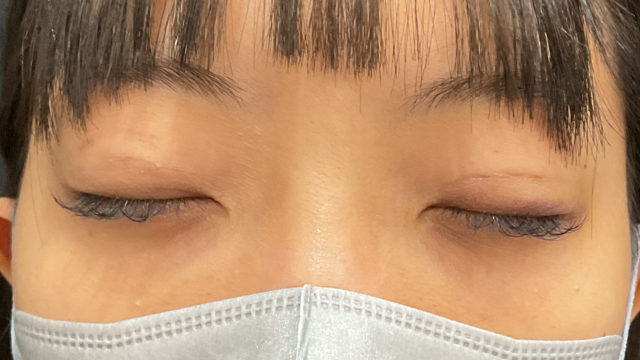 手術前の状態 その1