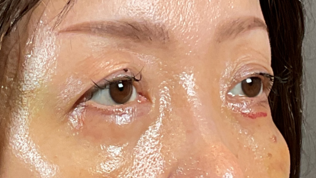 手術前の状態 その1