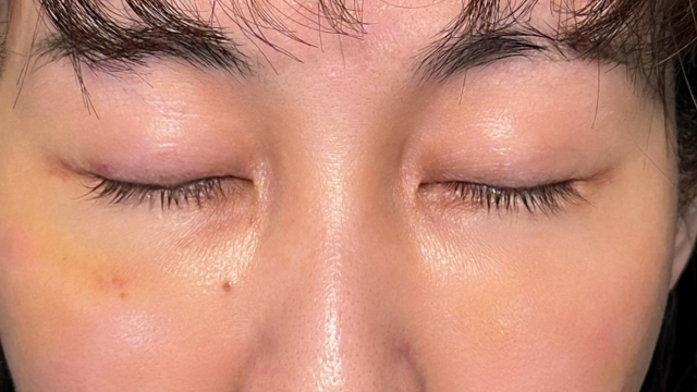 手術前の状態 その1