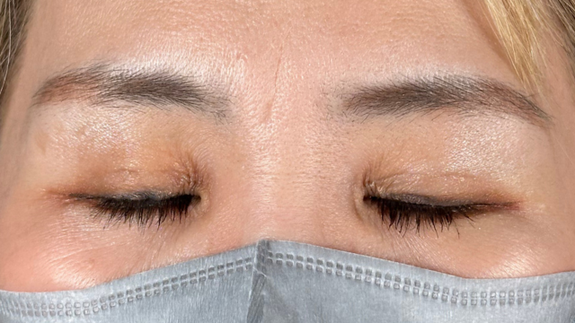 手術前の状態 その1