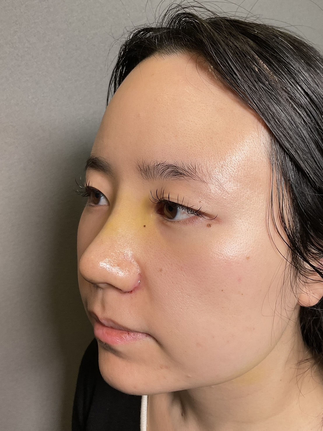 手術前の状態 その1