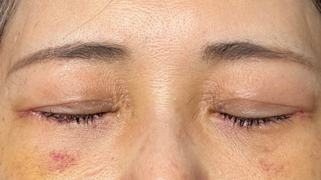 手術前の状態 その1