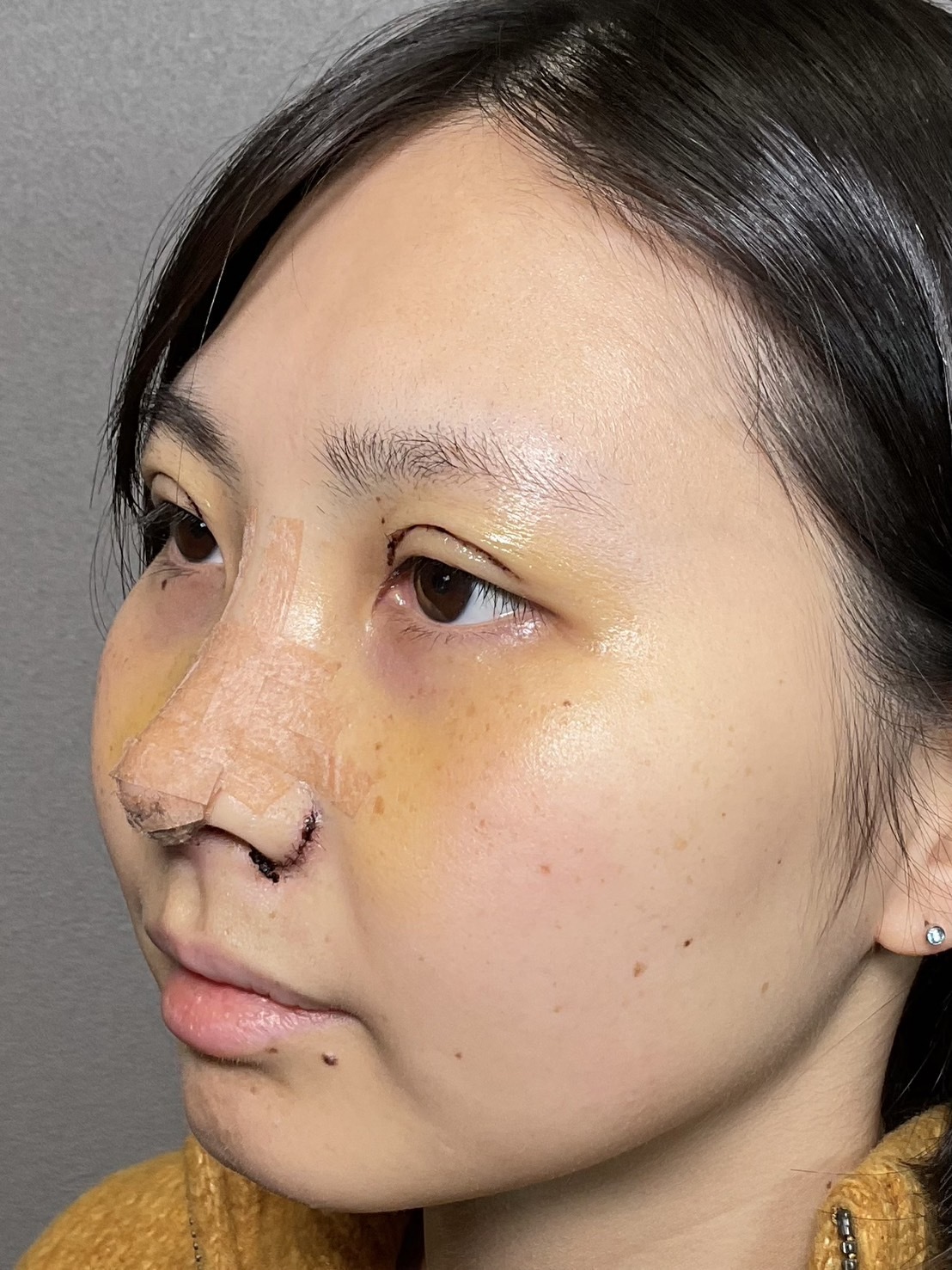 手術前の状態 その1