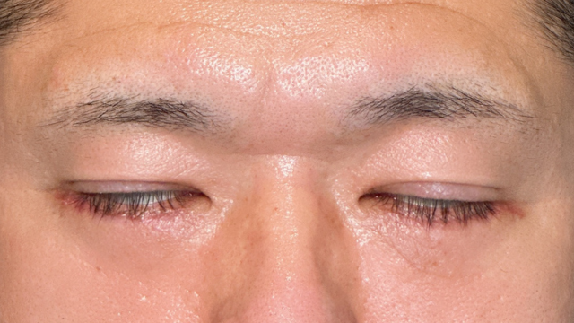 手術前の状態 その1