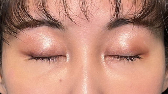 手術前の状態 その1