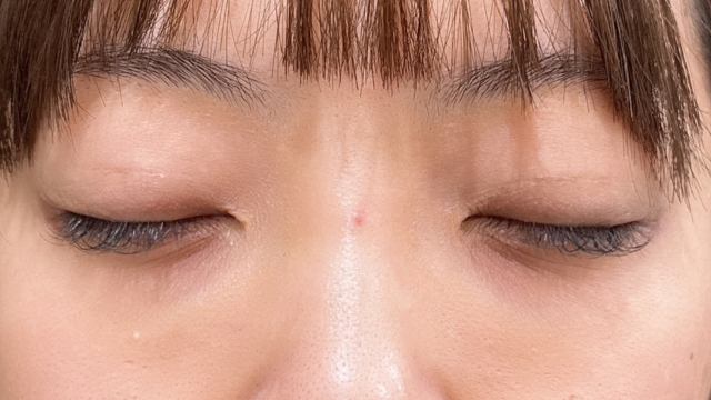 手術前の状態 その1