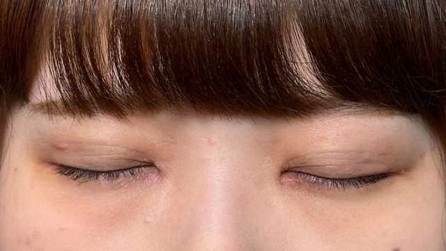 手術前の状態 その1