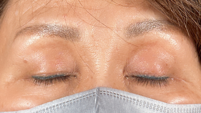 手術前の状態 その1