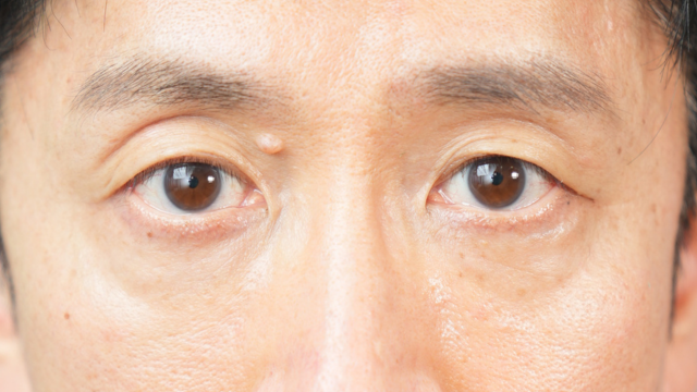 手術前の状態 その1