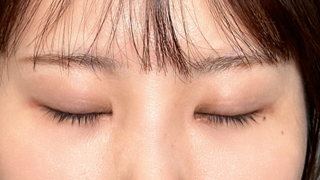 手術前の状態 その1