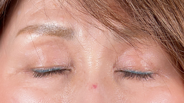 手術前の状態 その1