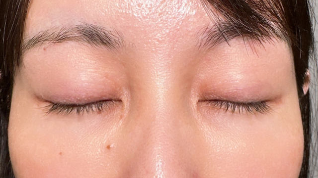 手術前の状態 その1